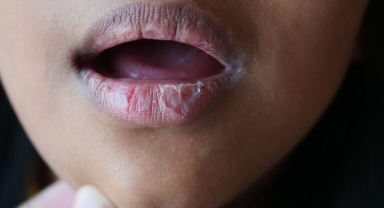 Heal Chapped Lips Fast: Dermatologist-Approved Remedies; Prevention Tips1