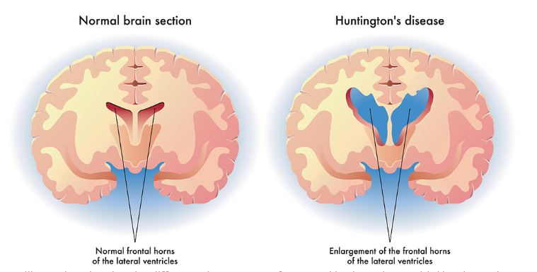 Micro RNA Technique Fighting Huntington Disease