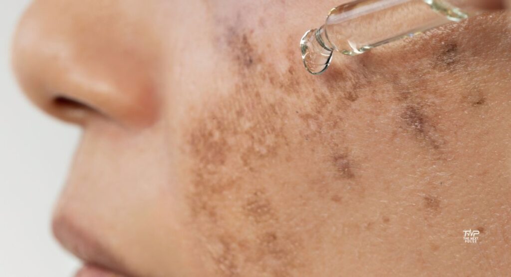 MELASMA22