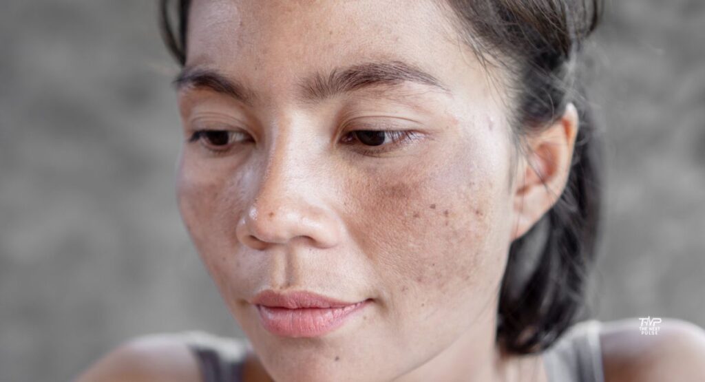 MELASMA23