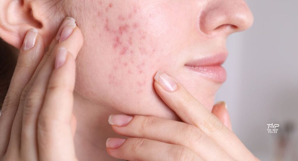 Treat Acne Naturally23
