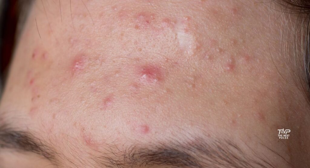 Treat Acne Naturally24