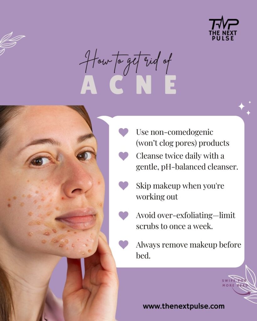 Treat Acne Naturally4