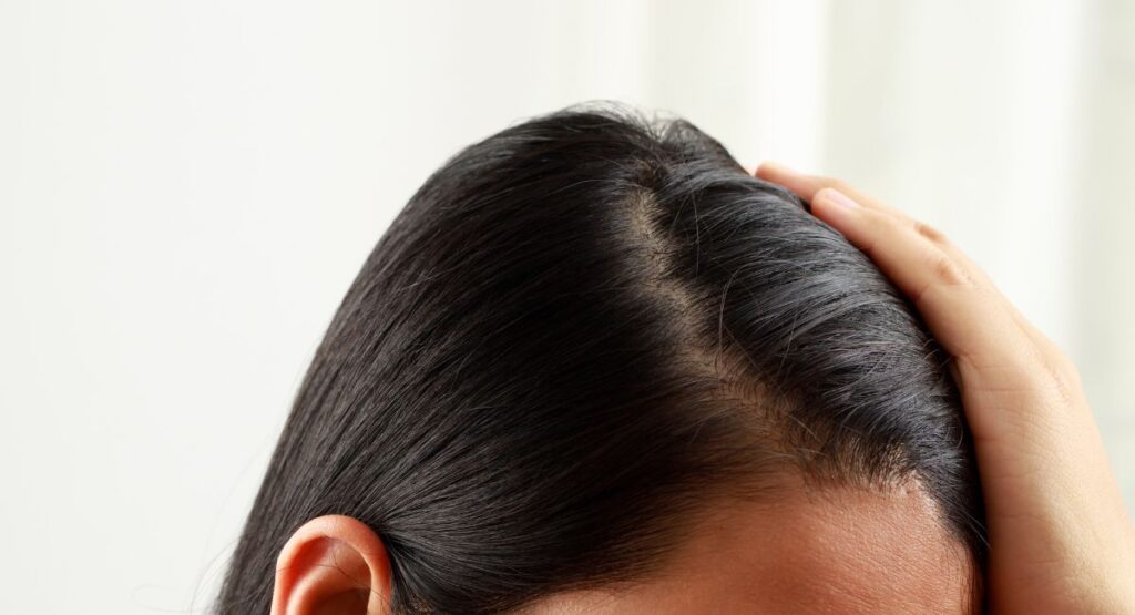 Treat an Oily Scalp Naturally
