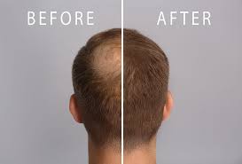 Advanced Hair Loss Prevention